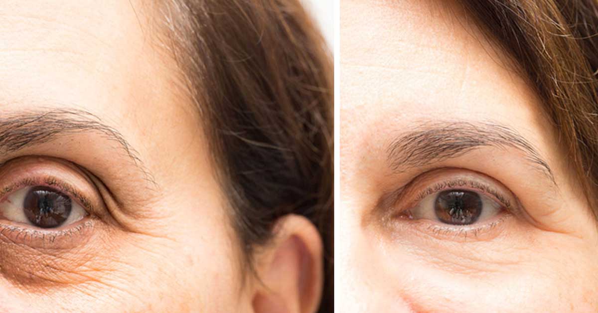 7 Remedies That Remove Dark Circles Fast 